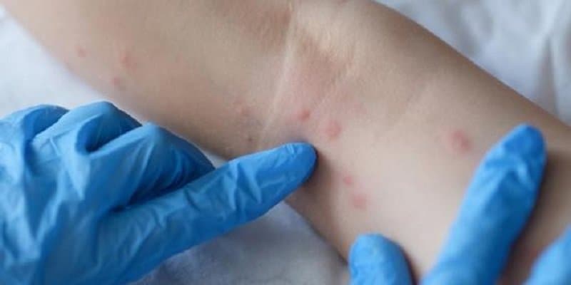 Le Maroc enregistre un nouveau cas confirmé de variole du singe