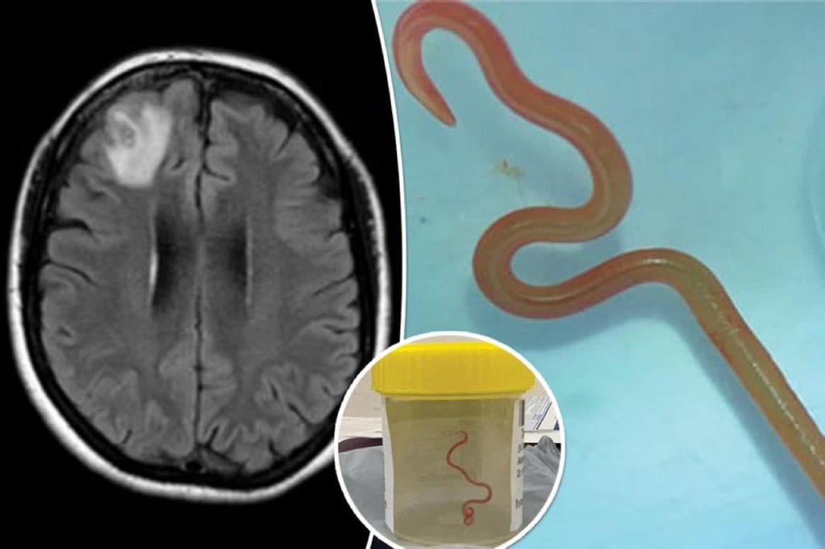 Du jamais-vu: Un ver vivant découvert dans le cerveau d'une Australienne