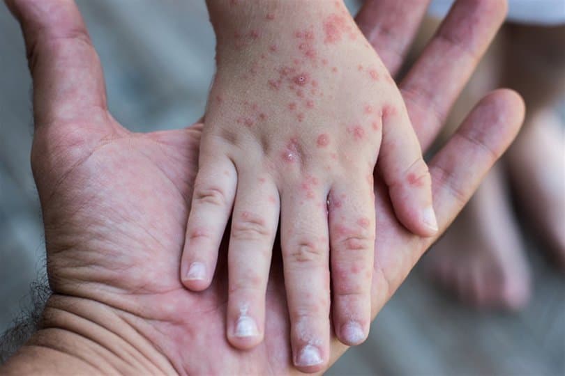 Le ministère de la Santé lance une vaste campagne de vaccination contre la rougeole