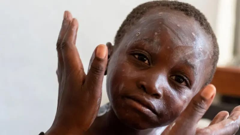 Faut-il s’inquiéter de la variole du singe ?