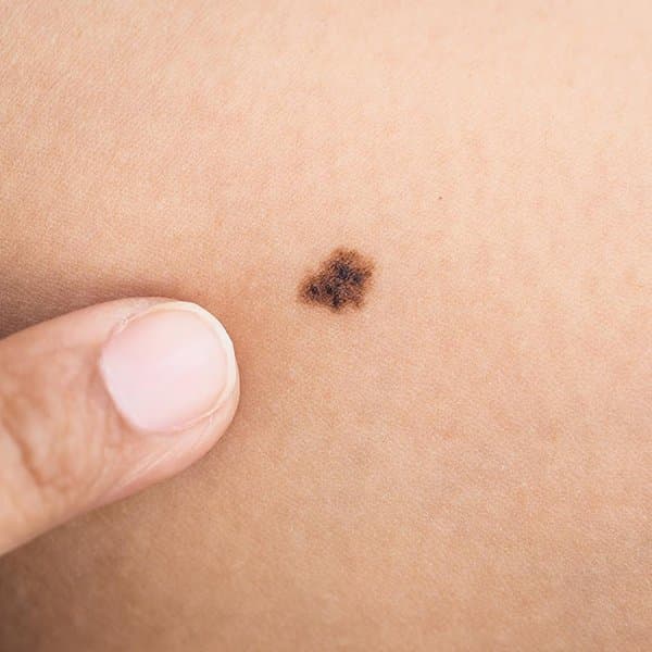 Faibles taux de cancer de la peau chez les jeunes en Suède