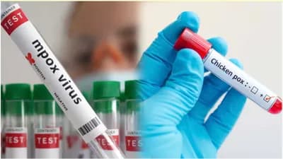 La Jordanie enregistre un cas de variole du singe