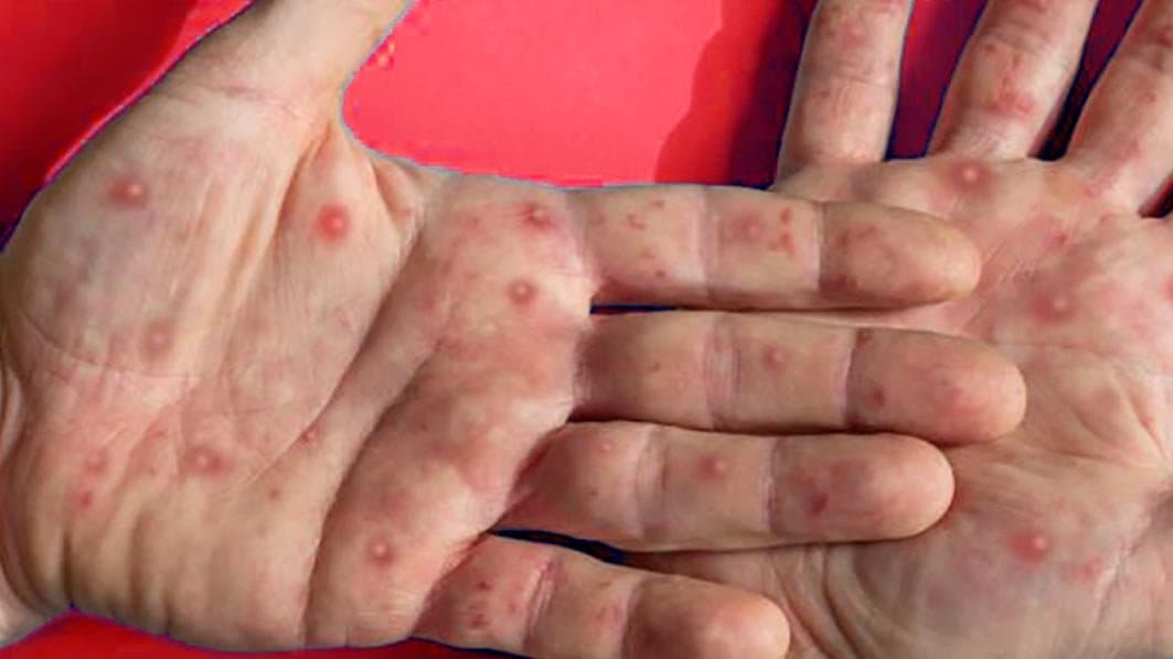 L’UNICEF alerte sur l’augmentation des cas de mpox au Burundi.