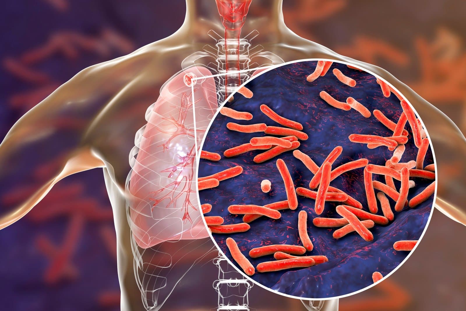 Tuberculose: Le dépistage renforcé au Maroc