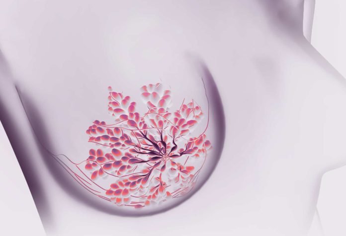 cancer-sein-cover-institut-sein-paris