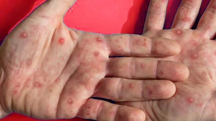 mpox brundais